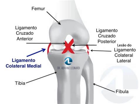 lesao no ligamento colateral medial do joelho